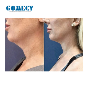 Máquina de Endolifting de Alta Potencia 30W 3000ms con Ancho de Pulso de 980nm y 1470nm - <span class=keywords><strong>Precio</strong></span> - Product Image 6