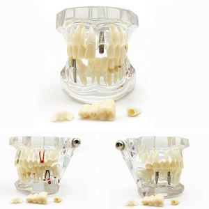 Tapón Dental 2x Grande, Cepillo de Dientes de Plástico/Niti/Acero Inoxidable, Eléctrico/Manual, Empaque Individual, Clase I para Enseñanza - Product Image 3
