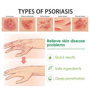 Оптовая продажа, новый травяной крем от экземы для детей, крем от псориаза, медицинское обслуживание - Product Image 6