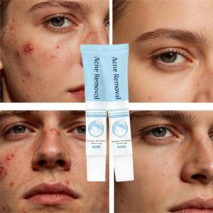 Gel anti-acné le plus vendu 2025 CE ISO MSDS, contrôle du sébum et prévention des cicatrices - Product Image 3