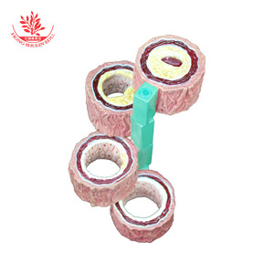 Modèle vasculaire, spécimen vasculaire pathologique en quatre étapes, démonstration de communication médecin-patient en cardiologie, vasculaire - Product Image 3