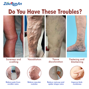 Ungüento para venas varicosas, venas, dolor, vasculitis, flebitis, pierna de araña, cuidado de la salud, crema de hierbas, alivia el dolor de piernas, suavizante - Product Image 2