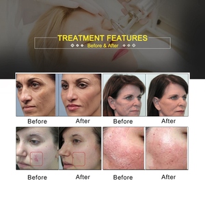 Máy trị liệu da bằng laser CO2, máy laser phân đoạn, máy xóa rạn da, máy laser CO2 cho da - Product Image 6