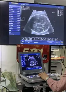 Beste Prijs 128 Elementen Cardiale Cw Medische Draagbare Echocardiografie Kleur Doppler Ultrasound Machine