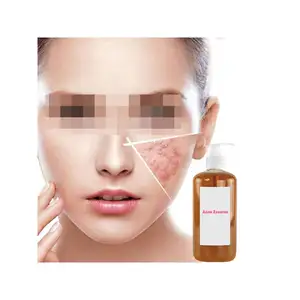 Goedkope Prijs Heldere Hardnekkige Acne Spot Behandeling Gel 10% Benzoylperoxide Acne Puistje Crème Voor Acne Gevoelige Huid
