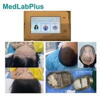 Machine de greffe de cheveux FUE, Punch FUE portable, Machine d'extraction de cheveux FUE pour cheveux longs et cheveux courts rasés