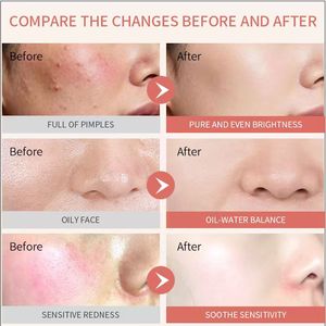 Suero Anti-Imperfecciones Big Drop Spot, Astringente Rápido, Eliminación de Granos de Acné de Emergencia, Reduce el Enrojecimiento y la Inflamación - Product Image 4