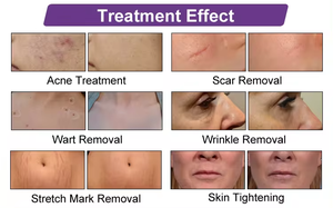 Máquina de Rejuvenecimiento Cutáneo con Láser Fraccional de CO2 de 10600nm para Tensado Vaginal, Eliminación de Acné, Eliminación de Arrugas y Cicatrices (Uso Comercial) - Product Image 6