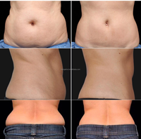 Machine laser Lipo Diode 980nm/Machine laser Lipo amincissante/Liposuccion laser Lipo 980nm Lifting facial Endolaser