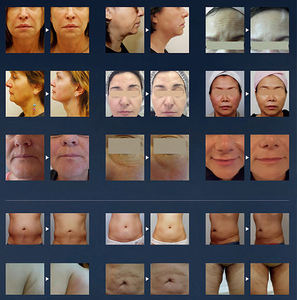 Dispositivo Hifi Liposónico Antienvejecimiento, Máquina de Estiramiento Facial, Cartuchos de Estiramiento SMAS, 2 Manijas, Estiramiento Facial, Adelgazamiento Corporal - Product Image 6