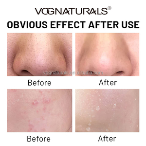 OEM Ensemble de soins de la <span class=keywords><strong>peau</strong></span> contre l'acné au peroxyde de benzoyle Nettoyant pour le <span class=keywords><strong>visage</strong></span> au peroxyde de benzoyle Crème réparatrice de toner acide - Product Image 6