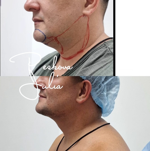 Endo Fiberlift 1470nm 980nm <span class=keywords><strong>Laser</strong></span> Liposuction, Raffermissement cutané, Lifting facial par fibres, Endolaser, Lipolyse, Appareil <span class=keywords><strong>laser</strong></span> - Product Image 6