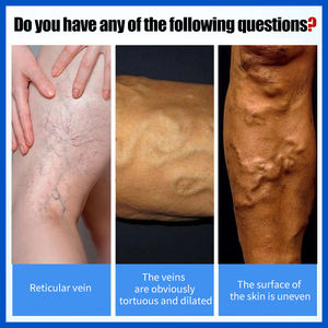 Efecto alemán seguro mejorar la elasticidad <span class=keywords><strong>vascular</strong></span> venoso calmante tradicional chino fiebre espontánea parche para venas varicosas - Product Image 3