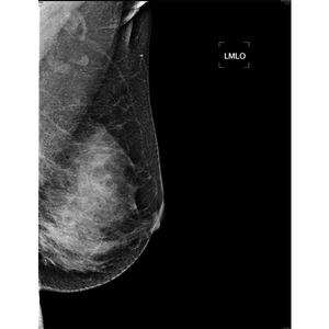 Mesin Mammografi <span class=keywords><strong>Digital</strong></span> 5kW untuk Dijual - Product Image 6