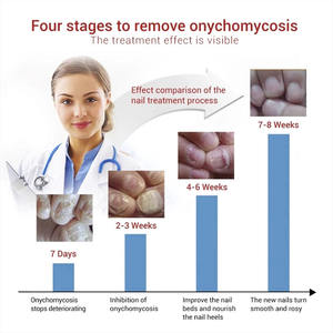 Suero de Tratamiento Herbal para Hongos en las Uñas, Elimina la Infección y Cuida los Pies, 10 ml - Product Image 3
