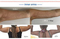 Appareil de remodelage corporel esthétique par lipolyse laser plastique, lifting endolaser, machine de lifting endo laser