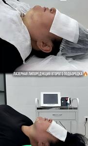 Appareil d'injectation pour <span class=keywords><strong>lipolyse</strong></span> et dissolution des graisses, Laser Endolaser pour liposuccion corporelle, lifting du visage et élimination du <span class=keywords><strong>double</strong></span> <span class=keywords><strong>menton</strong></span>, Fibre Slim 980nm 1470nm - Product Image 4