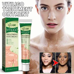 EELHOE Vitiligo Traitement Crème Ointment pour l'élimination des <span class=keywords><strong>taches</strong></span> <span class=keywords><strong>blanches</strong></span>, de la teigne, de la leucoplasie cutanée et de la dermatite 20ml EELHOE Vitiligo - Product Image 3