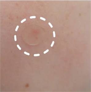 แผ่นแปะสิวไฮโดรคอลลอยด์แบบใส มองไม่เห็นบนผิวหนังขณะสวมใส่ทั้งกลางวันและกลางคืน - Product Image 4