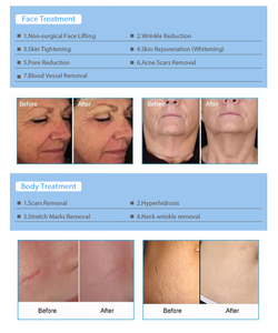 Máquina Portátil de Radiofrecuencia Fraccionada con Microagujas de Oro para Rejuvenecimiento Facial y Estiramiento de la <span class=keywords><strong>Piel</strong></span>, Cartuchos de Microagujas - Product Image 3