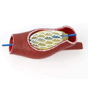 Modelo de <span class=keywords><strong>stent</strong></span> vascular humano KyrenMed, soporte de bloqueo de vasos sanguíneos cardiovasculares de arteria coronaria, modelo de bloqueo de vasos sanguíneos - Product Image 4