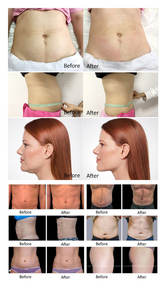 Precio Promocional: Máquina Portátil 2 en 1 de Crioterapia 360° para Reducción de Grasa y Papada, Adelgazamiento Facial, con 3 Manípulos de Metal ABS - Product Image 6