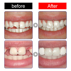 JAYSUING <span class=keywords><strong>Pegamento</strong></span> Sólido de 30 ml para <span class=keywords><strong>Dientes</strong></span> Postizos Temporales, Moldeable, Reutilizable, Multiusos, Accesorios para Blanqueamiento Dental para Maquillaje de Vacaciones - Product Image 6
