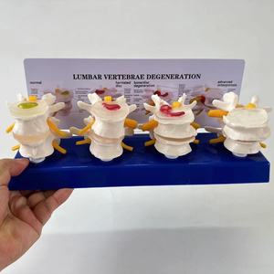 แบบจำลองการบีบอัดหมอนรองกระดูกที่แตกหักแบบสี่ขั้นตอน ตั้งแต่สุขภาพดีไปจนถึงภาวะหมอนรองกระดูกที่แตกหัก - Product Image 6