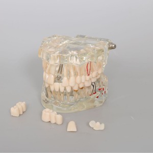 Modèle dentaire transparent de haute qualité, nouveau modèle d'affichage pathologique pour prothèses dentaires et implants - Product Image 4