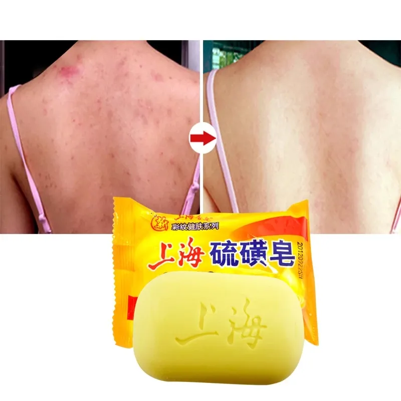 Shanghai Schwefels eife für die Hautöl kontrolle Gesichts reinigung Ekzem Pickel Milbe Akne Entferner Bad Gesunde saubere Hautpflege