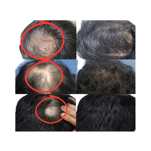 100% coreano naturale per la cura del cuoio capelluto fusione-probiotici olio-controllo Anti-perdita di capelli ricrescita dei capelli prevenzione della perdita di capelli - Product Image 1