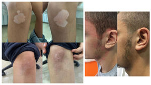 Lámpara Portátil de Fototerapia UVB Clínica para Trastornos de la Piel, Vitíligo, Psoriasis y <span class=keywords><strong>Dermatitis</strong></span> Atópica, Modelo KN-4003BL 311nm - Product Image 6