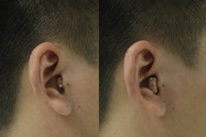 Audífonos Intrauditivos Mini Personalizables con 16 Canales, Amplificador Recargable <span class=keywords><strong>para</strong></span> Pérdida Auditiva, Grado Médico - Product Image 3