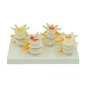 Modello di Colonna Vertebrale Lombare Patologica Umana a 4 Stadi, Modello Realistico di Lesioni della Colonna Lombare, Strumento Didattico Medico - Product Image 5