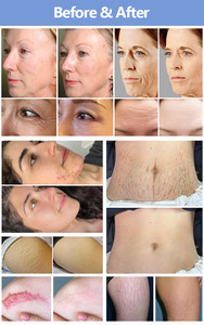 เครื่องมือความงาม 6 in 1 RF Microneedle สำหรับรักษาแผลเป็นจากสิว รอยแตกลาย ฟื้นฟูผิว ใช้ในร้านเสริมสวย - Product Image 6