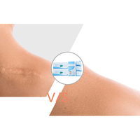 Rouleau de ruban adhésif en silicone de qualité médicale réutilisable et imperméable pour la réduction des cicatrices de césarienne, chirurgicales, chéloïdes et vergetures
