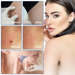 Skin Tag <strong>Removal</strong> Silicone Bands Elastic Groin <strong>Wart</strong> Mole <strong>Removing</strong> Rubber Ring Kit With Alcohol Pad - Product Image 5