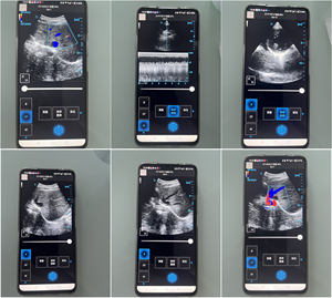 Full Digital Medical Sonda Sem Fio Ultrassom Scanner 3 em 1 Cor Sonda Portátil Doppler Portátil - Product Image 3