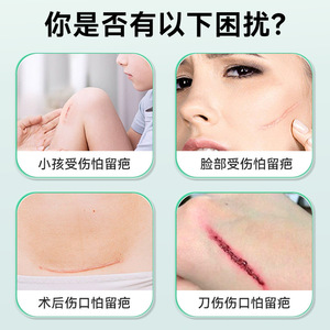 Pansement élastique tunnelisé réducteur de tension pour sutures cutanées, type fermeture éclair, pour pansement postopératoire sans suture, souple - Product Image 2