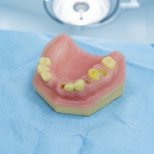 Zahnmedizinisches Anatomisches Modell für Sofortige Implantationspraxis in der Medizinischen Wissenschaft <span class=keywords><strong>UMG</strong></span> UM-2044 - Product Image 1