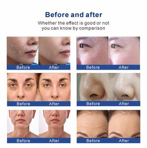 Analyseur <span class=keywords><strong>de</strong></span> peau multifonctionnel à prix d'usine, appareil facial Hydra Dermabrasion, microdermabrasion pour le traitement <span class=keywords><strong>de</strong></span> l'acné et des points noirs - Product Image 6