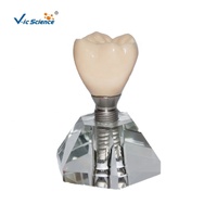 Modèle d'implant dentaire stéréoscopique Dents et modèle dentaire Modèle d'implant dentaire pour les applications en sciences médicales