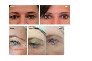 Mesin Pengencang kulit, peralatan spa kecantikan estetika mesin pengangkat - Product Image 5