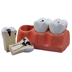 Dientes con desarrollo de caries, 3 etapas, 4x, tamaño real, 7 piezas, modelo de enseñanza médica, Material de PVC - Product Image 1