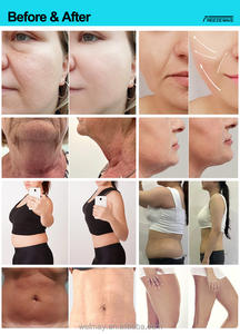 Nieuwste Ontwerp Cryo Apparaat Ijskoeling Bevriezen Professionele Cavitatie En Radiofrequentie Cavitatie Magnetron Cryotherapie Machine - Product Image 6