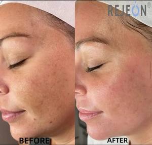 Ingredientes patentados de Rejon, suero de eliminación de pecas suave y no irritante de tiamidol - Product Image 3