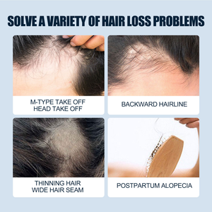 Tốt nhất bán Nhân Sâm Radix polygoni mọc lại huyết thanh chăm sóc tóc điều trị da đầu carehair tăng trưởng phun - Product Image 5