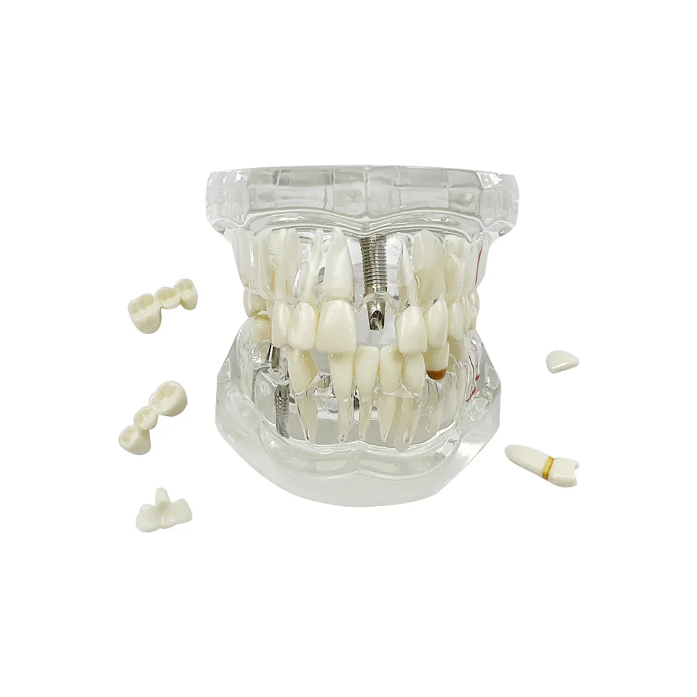 Standaard Tandheelkundige Tanden Model Implantaatziekte Tandarts Bestudeert Demo Tandheelkundige Typodont Model Met Verwijderbare Tanden Restauratiebrug