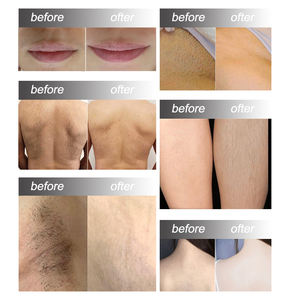 Depiladora Diodo 2 en 1 Sunrise, Depiladora Permanente de Diodo, Máquina de Depilación Láser de Diodo Vertical - Product Image 6