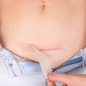 Alnlike SC0420 Patch cicatrisant en silicone hypoallergénique de qualité médicale, respectueux de la peau, réutilisable et résistant à l'eau, pour cicatrices post-chirurgicales - Product Image 2